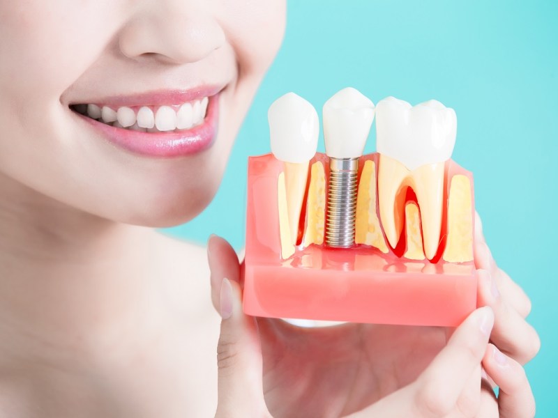 Why Dental Implants Are More Than Just a Cosmetic&nbsp;Solution